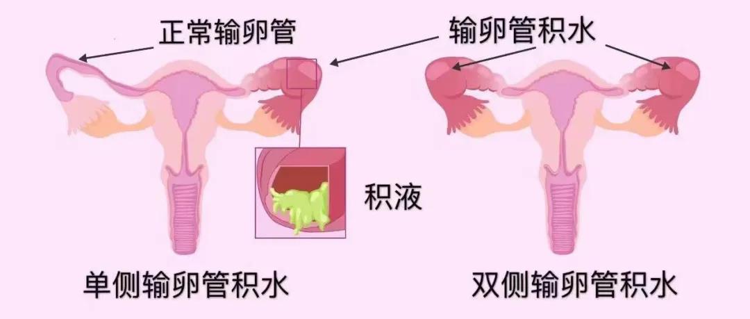 泰国第三代试管婴儿